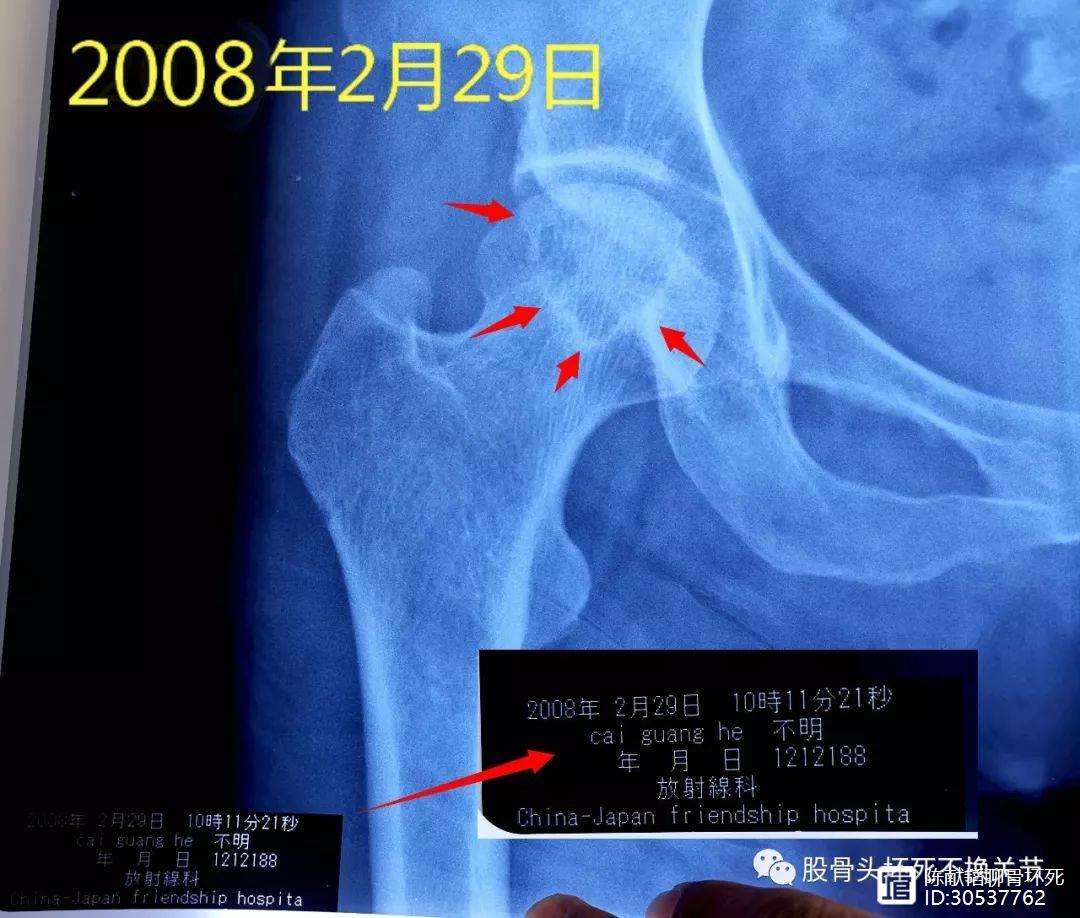 洛阳人工骨头医保报销多少(人工骨头医保报销多少比例)